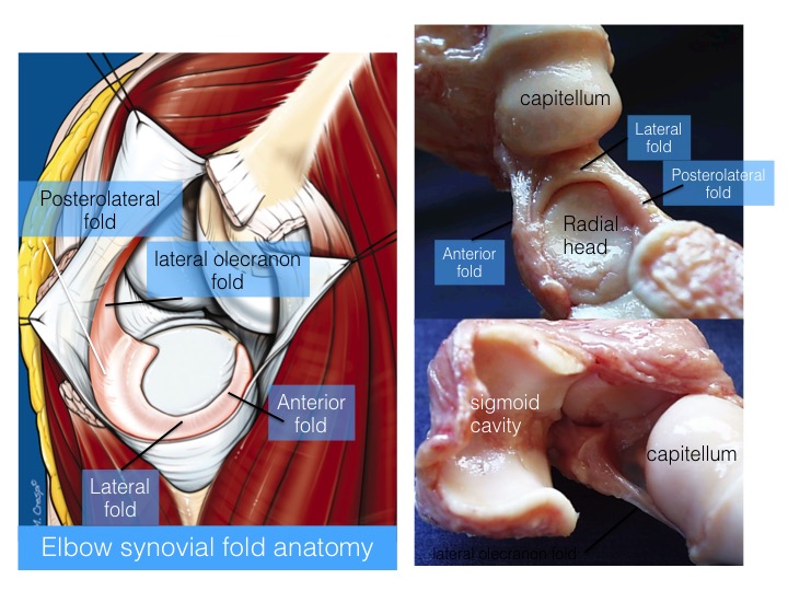 Figure 5 for case Elbow synovial fold syndrome (posterolateral impingement)